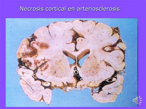 cid 10 infarto cerebral